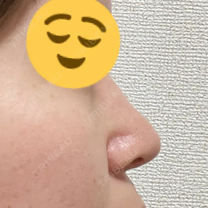 鼻修正 / 鼻孔縁下降 牧野美容クリニック DAY 17 メイン用