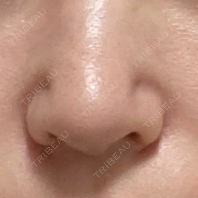 鼻修正 / 鼻孔縁下降 牧野美容クリニック DAY 17 メイン用