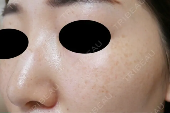 フォトRF 湘南美容クリニック 岡山院 DAY 147 メイン用