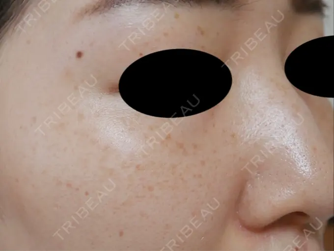 フォトRF 湘南美容クリニック 岡山院 DAY 147 メイン用