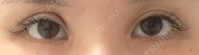 二重切開 / 蒙古ひだ形成 R.O.clinic AFTER メイン用