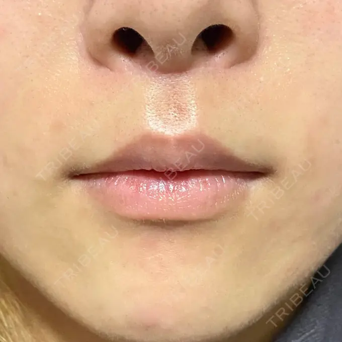 人中短縮 新宿ラクル美容外科クリニック 新宿院 AFTER メイン用