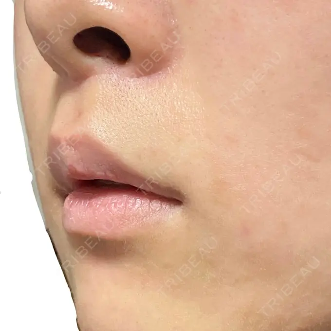 人中短縮 新宿ラクル美容外科クリニック 新宿院 DAY 150 メイン用