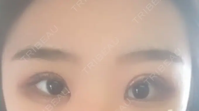 二重切開 / 目頭切開 / 眼瞼下垂（切開） / その他（目元） ブリスクリニック形成外科・美容外科・美容皮膚科 福岡 DAY 6 メイン用