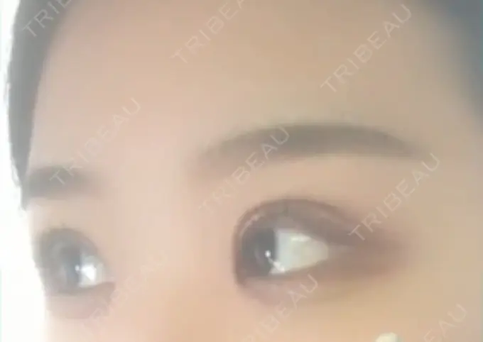 二重切開 / 目頭切開 / 眼瞼下垂（切開） / その他（目元） ブリスクリニック形成外科・美容外科・美容皮膚科 福岡 DAY 6 メイン用