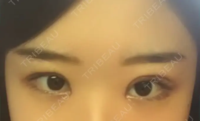 二重切開 / 目頭切開 / 眼瞼下垂（切開） / その他（目元） ブリスクリニック形成外科・美容外科・美容皮膚科 福岡 DAY 7 メイン用