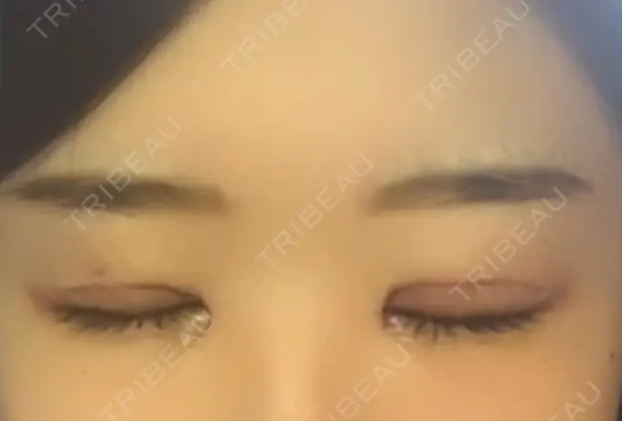 二重切開 / 目頭切開 / 眼瞼下垂（切開） / その他（目元） ブリスクリニック形成外科・美容外科・美容皮膚科 福岡 DAY 7 メイン用