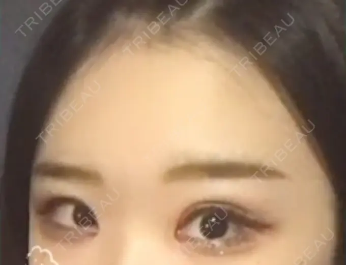 二重切開 / 目頭切開 / 眼瞼下垂（切開） / その他（目元） ブリスクリニック形成外科・美容外科・美容皮膚科 福岡 DAY 7 メイン用