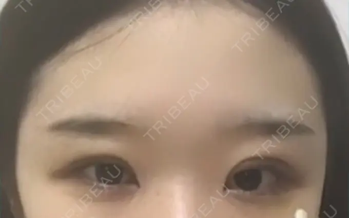 二重切開 / 目頭切開 / 眼瞼下垂（切開） / その他（目元） ブリスクリニック形成外科・美容外科・美容皮膚科 福岡 AFTER メイン用