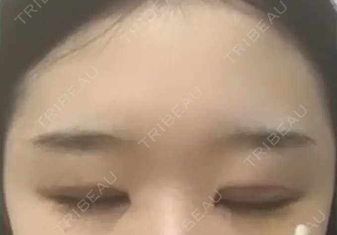 二重切開 / 目頭切開 / 眼瞼下垂（切開） / その他（目元） ブリスクリニック形成外科・美容外科・美容皮膚科 福岡 DAY 8 メイン用