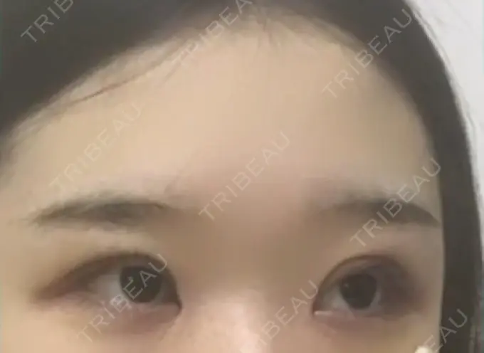 二重切開 / 目頭切開 / 眼瞼下垂（切開） / その他（目元） ブリスクリニック形成外科・美容外科・美容皮膚科 福岡 DAY 8 メイン用