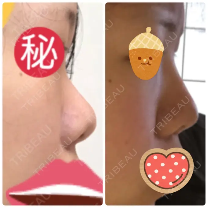 隆鼻術 / 鼻中隔延長（切開） / 鼻尖縮小 みずほクリニック DAY 410 メイン用