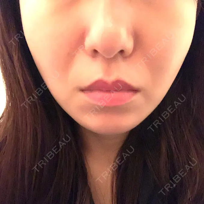 糸リフト / 脂肪吸引（顔） / メーラーファット除去 / ボトックス（エラ・小顔） 湘南美容クリニック 秋葉原院 DAY 140 メイン用