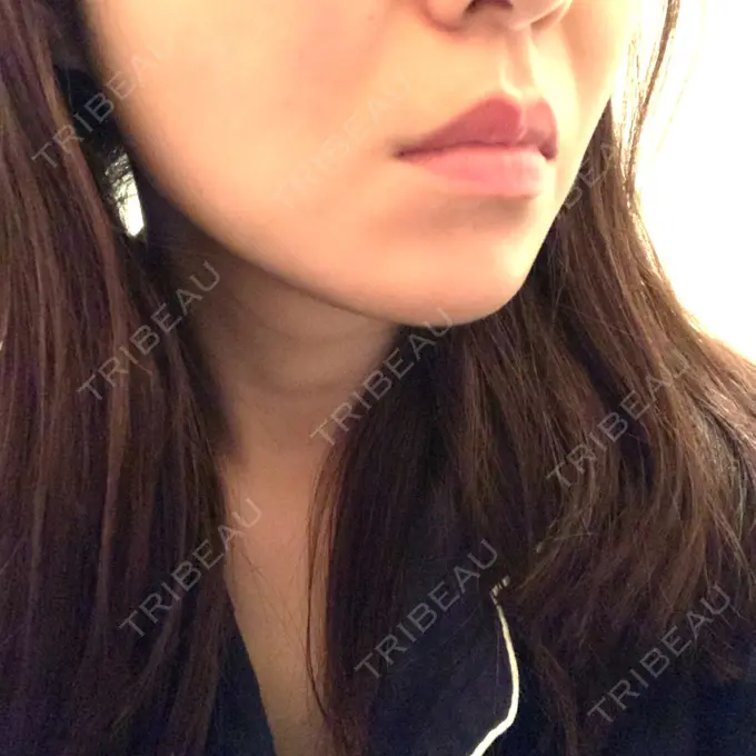 糸リフト / 脂肪吸引（顔） / メーラーファット除去 / ボトックス（エラ・小顔） 湘南美容クリニック 秋葉原院 DAY 140 メイン用