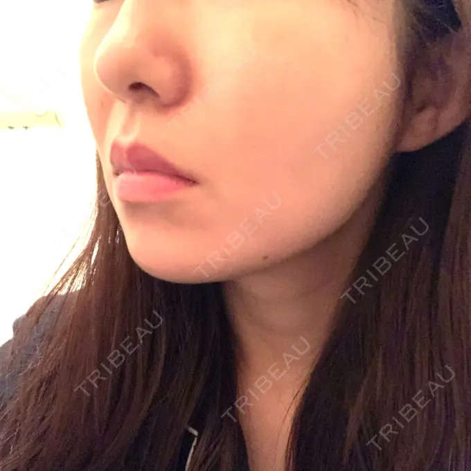 糸リフト / 脂肪吸引（顔） / メーラーファット除去 / ボトックス（エラ・小顔） 湘南美容クリニック 秋葉原院 DAY 140 メイン用