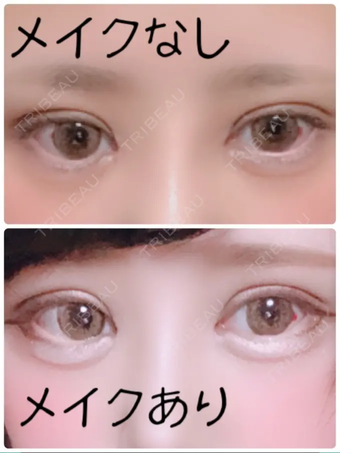 二重切開 / 目頭切開 / ヒアルロン酸注入（涙袋） FROM B整形外科 (旧バウム整形外科) DAY 11 メイン用