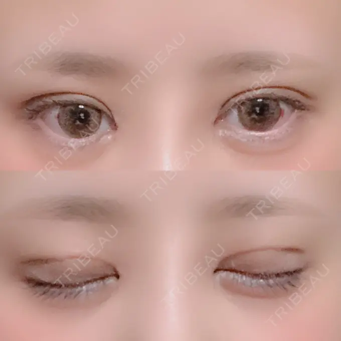 二重切開 / 目頭切開 / ヒアルロン酸注入（涙袋） FROM B整形外科 (旧バウム整形外科) DAY 11 メイン用