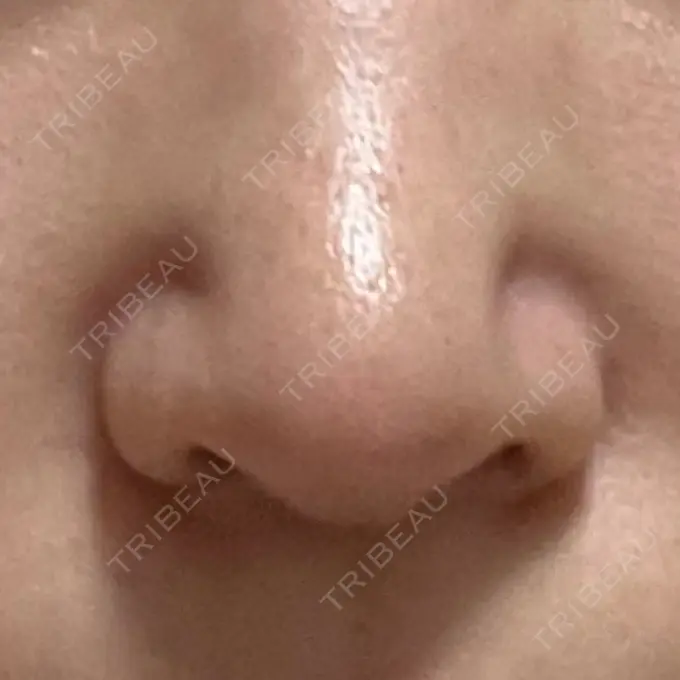 鼻修正 / 鼻孔縁下降 牧野美容クリニック DAY 22 メイン用