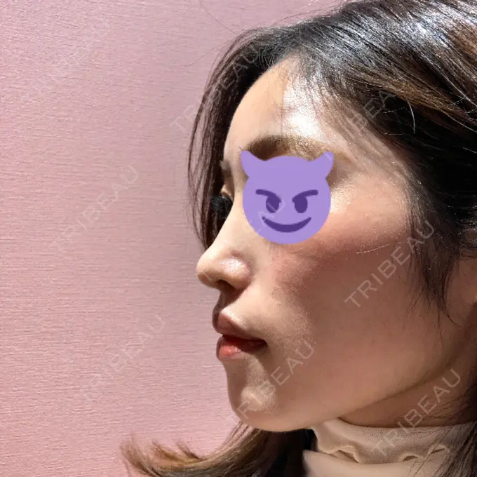 鼻中隔延長（切開） / 小鼻縮小（切開） みずほクリニック AFTER メイン用