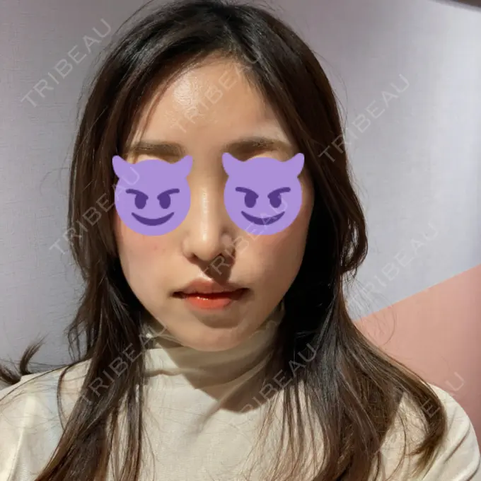 鼻中隔延長（切開） / 小鼻縮小（切開） みずほクリニック DAY 55 メイン用