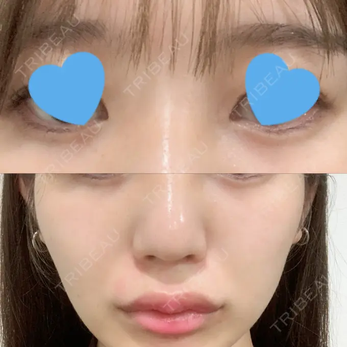 ヒアルロン酸注入（涙袋） / ヒアルロン酸注入（鼻） / ヒアルロン酸注入（唇） / ボトックス（口角） ルラ美容クリニック 大宮院 / ルラスキンクリニック 大宮院 DAY 2 メイン用