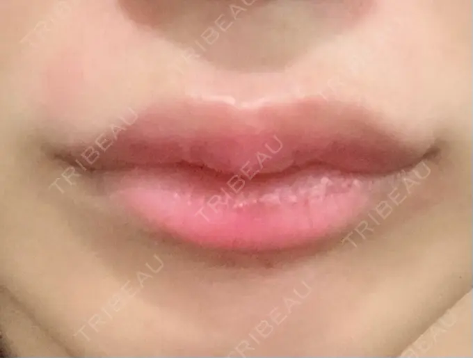 ヒアルロン酸注入（涙袋） / ヒアルロン酸注入（鼻） / ヒアルロン酸注入（唇） / ボトックス（口角） ルラ美容クリニック 大宮院 / ルラスキンクリニック 大宮院 DAY 2 メイン用