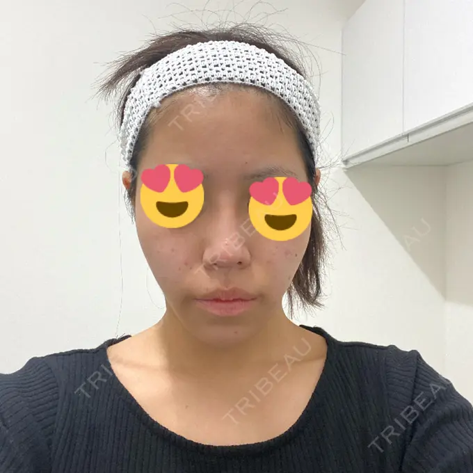 隆鼻術 / 鼻中隔延長（切開） みずほクリニック AFTER メイン用