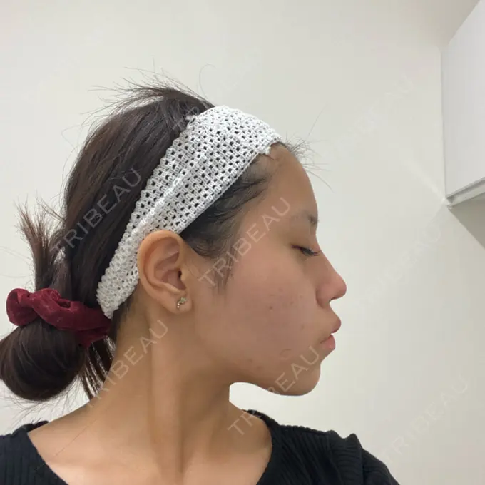 隆鼻術 / 鼻中隔延長（切開） みずほクリニック DAY 44 メイン用