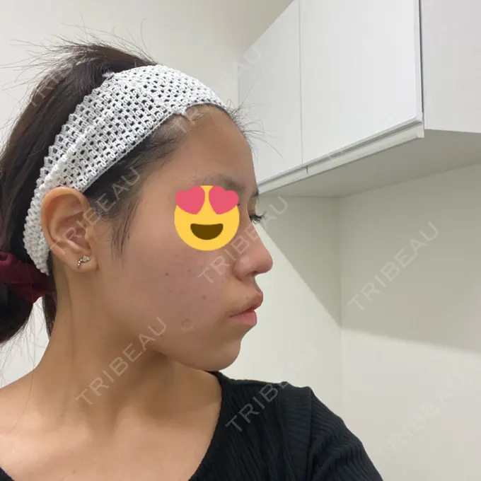 隆鼻術 / 鼻中隔延長（切開） みずほクリニック DAY 44 メイン用