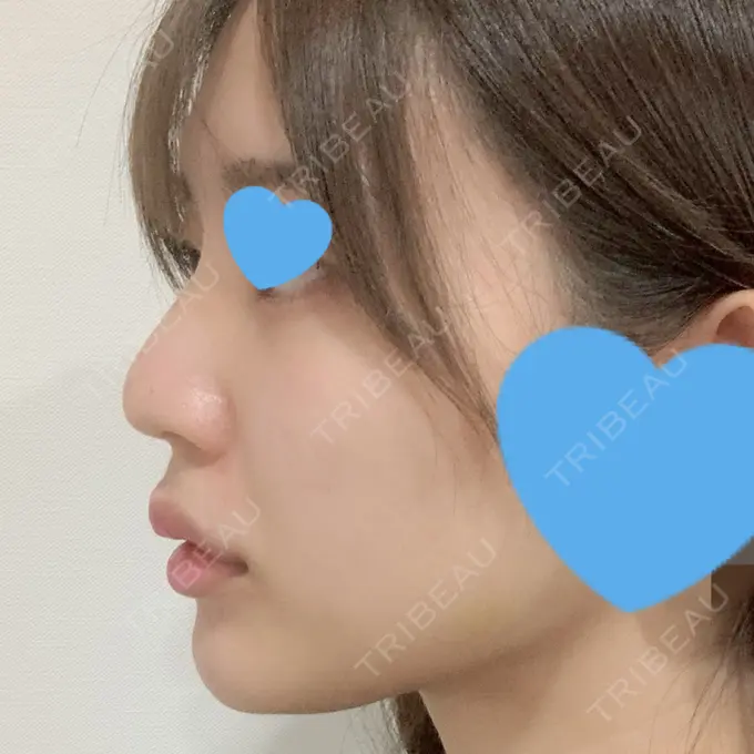 ヒアルロン酸注入（涙袋） / ヒアルロン酸注入（鼻） / ヒアルロン酸注入（唇） / ボトックス（口角） ルラ美容クリニック 大宮院 / ルラスキンクリニック 大宮院 DAY 2 メイン用