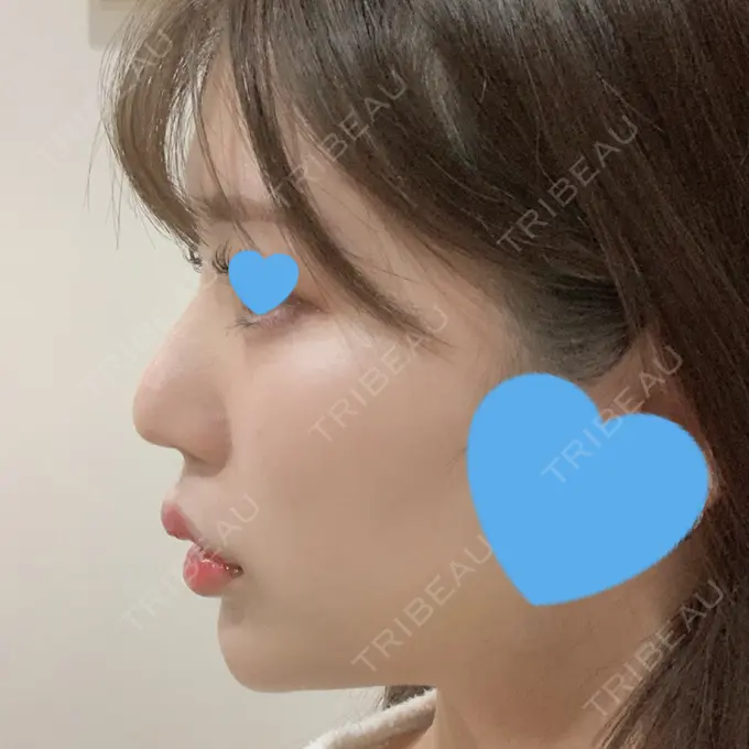 ヒアルロン酸注入（涙袋） / ヒアルロン酸注入（鼻） / ヒアルロン酸注入（唇） / ボトックス（口角） ルラ美容クリニック 大宮院 / ルラスキンクリニック 大宮院 DAY 3 メイン用