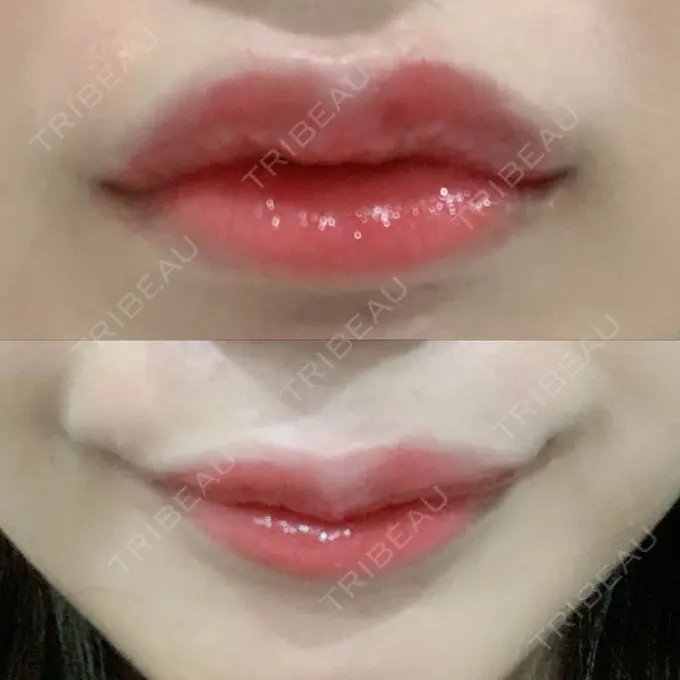 ヒアルロン酸注入（涙袋） / ヒアルロン酸注入（鼻） / ヒアルロン酸注入（唇） / ボトックス（口角） ルラ美容クリニック 大宮院 / ルラスキンクリニック 大宮院 DAY 3 メイン用