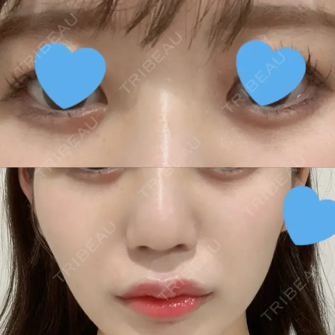 ヒアルロン酸注入（涙袋） / ヒアルロン酸注入（鼻） / ヒアルロン酸注入（唇） / ボトックス（口角） ルラ美容クリニック 大宮院 / ルラスキンクリニック 大宮院 DAY 3 メイン用