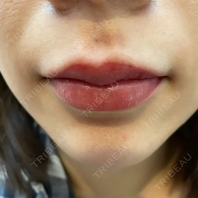 アートメイク（唇） LEAGRANT CLINIC 中目黒 DAY 2 メイン用