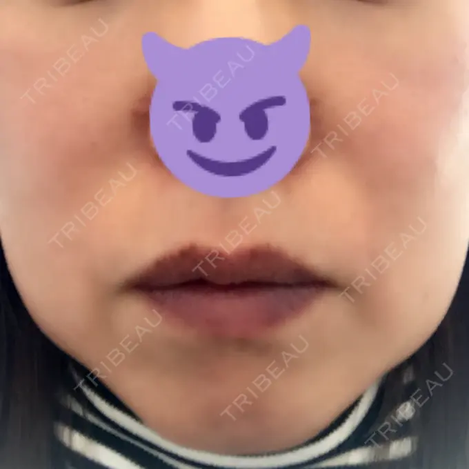 脂肪溶解注射（顔） 湘南美容クリニック 東京蒲田院 DAY 0 メイン用