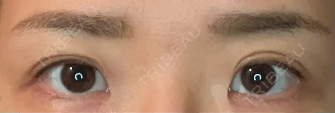 二重埋没 東京BELLEZZAクリニック DAY 164 メイン用