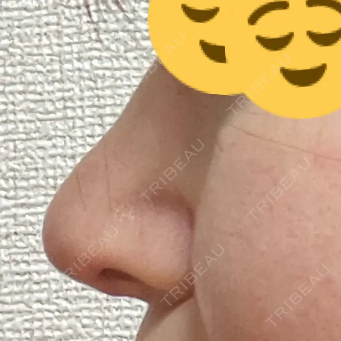 鼻修正 / 鼻孔縁下降 牧野美容クリニック DAY 31 メイン用