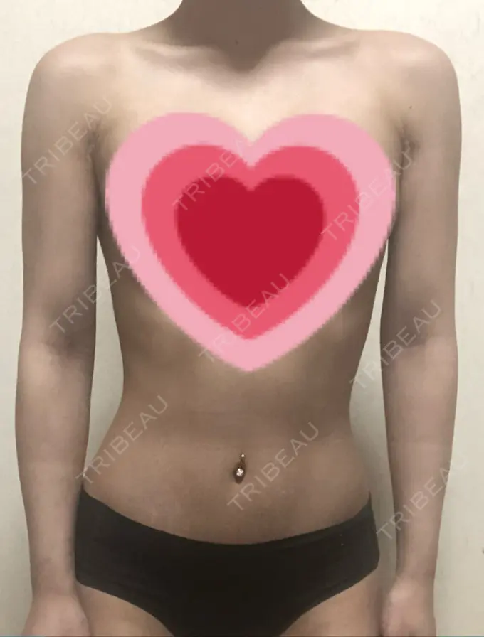 脂肪吸引（二の腕） ヨンセスリムライン DAY 19 メイン用