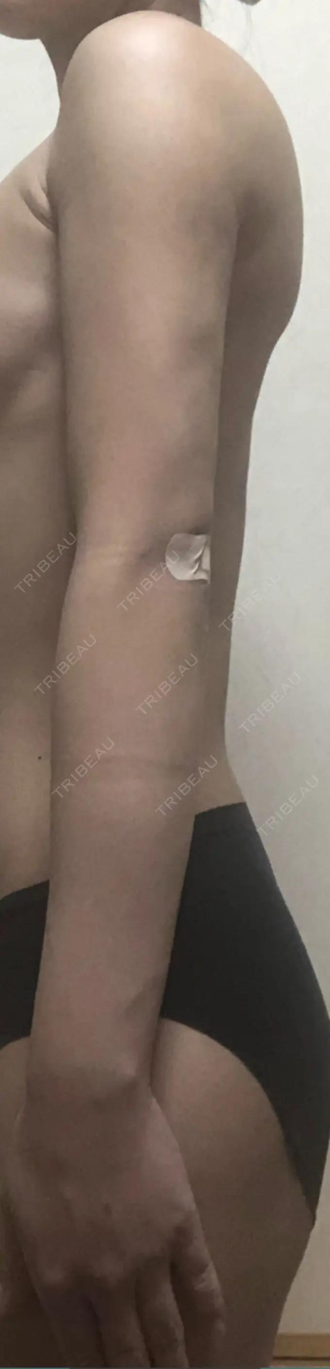 脂肪吸引（二の腕） ヨンセスリムライン DAY 19 メイン用