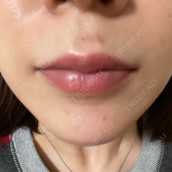 アートメイク（唇） LEAGRANT CLINIC 中目黒 DAY 4 メイン用