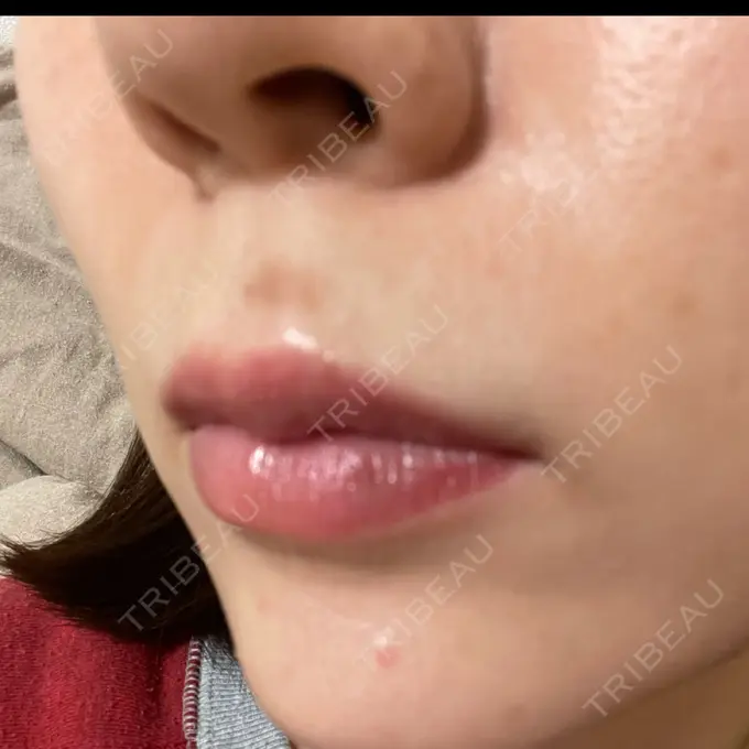 アートメイク（唇） LEAGRANT CLINIC 中目黒 DAY 4 メイン用