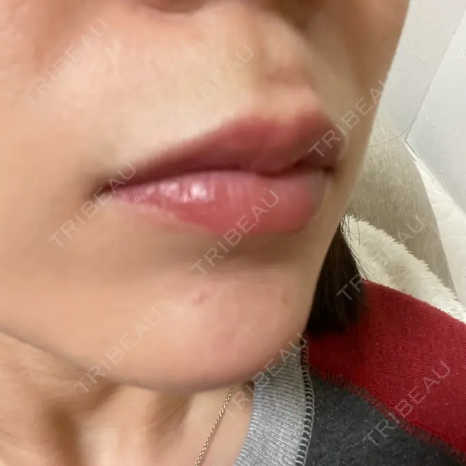 アートメイク（唇） LEAGRANT CLINIC 中目黒 DAY 4 メイン用