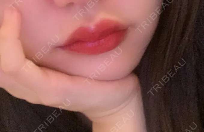 口角挙上 eクリニック 金沢本院 AFTER メイン用