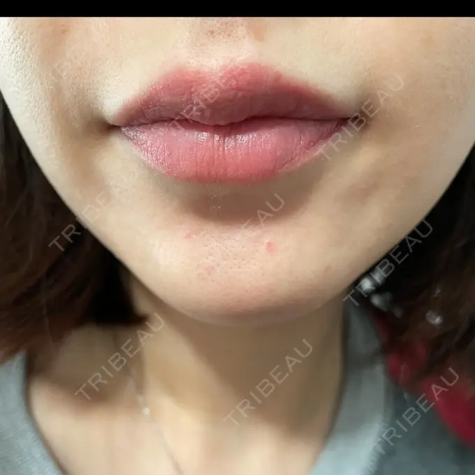 アートメイク（唇） LEAGRANT CLINIC 中目黒 DAY 5 メイン用