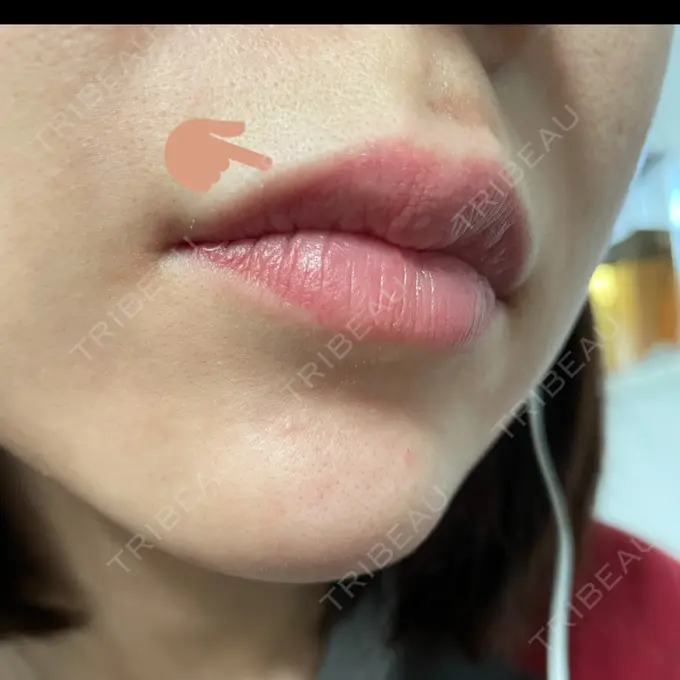 アートメイク（唇） LEAGRANT CLINIC 中目黒 DAY 5 メイン用