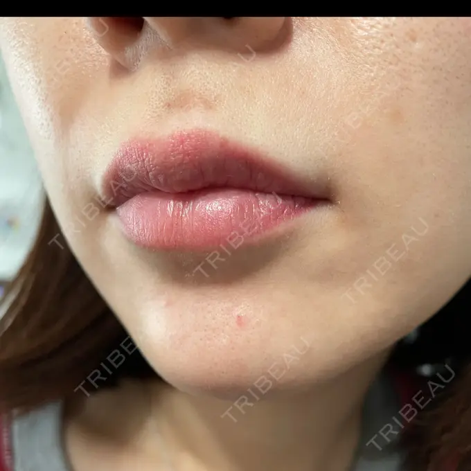 アートメイク（唇） LEAGRANT CLINIC 中目黒 DAY 5 メイン用