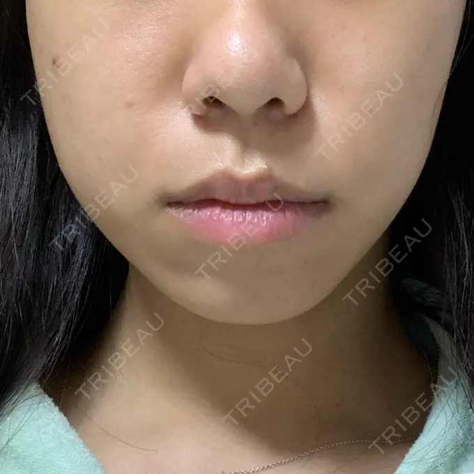 肌ヒアルロン酸注入（たるみ・シワ改善） / ボトックス（エラ・小顔） / その他（鼻） YBC横浜美容外科 大宮院 DAY 7 メイン用