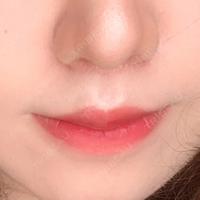 人中短縮 / ボトックス（口角） 新宿ラクル美容外科クリニック 新宿院 AFTER メイン用