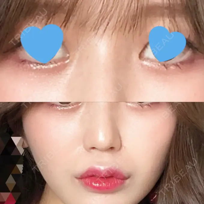 ヒアルロン酸注入（涙袋） / ヒアルロン酸注入（鼻） / ヒアルロン酸注入（唇） / ボトックス（口角） ルラ美容クリニック 大宮院 / ルラスキンクリニック 大宮院 AFTER メイン用