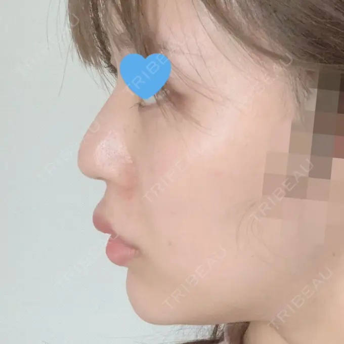 ヒアルロン酸注入（涙袋） / ヒアルロン酸注入（鼻） / ヒアルロン酸注入（唇） / ボトックス（口角） ルラ美容クリニック 大宮院 / ルラスキンクリニック 大宮院 DAY 10 メイン用